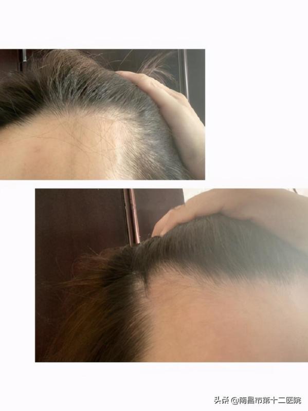 小姐姐分享自己的植發經歷，不得不說真的加分不少